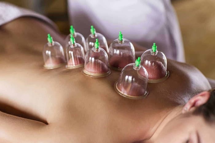 cupping-therapy-mountain-top-pa-maureen-kaminski