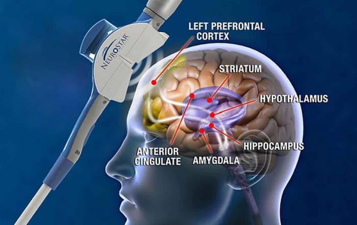 TMS-Magnetic-Brain-Stimulation