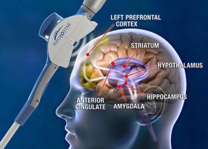 TMS-Magnetic-Brain-Stimulation